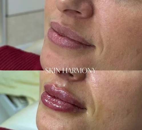 Preenchimento Facial para Harmonização Natural