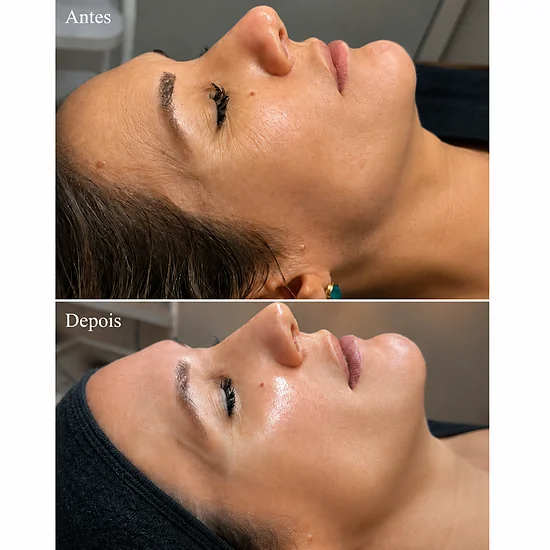 Hollywood Peel para pele renovada e iluminada