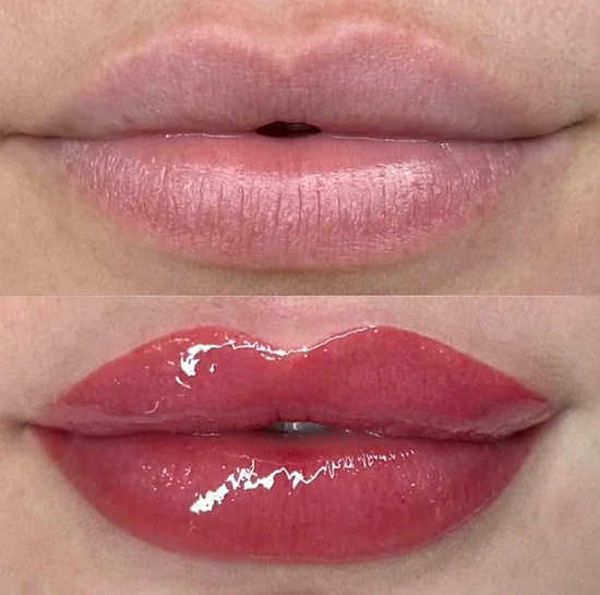 Micropigmentação Labial + Hydra Lips