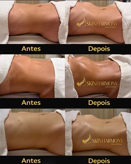 Hidrolipo: 4 sessões para gordura localizada